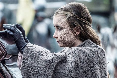 Game of Thrones, Greyscale and the Real History of Leprosy .